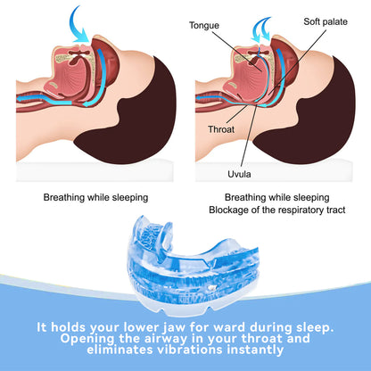 Adjustable Nighttime Dental Guard – Anti-Grinding Protection